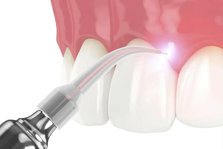 Soft tissue laser at Tysons Dental Spa in Vienna, VA.